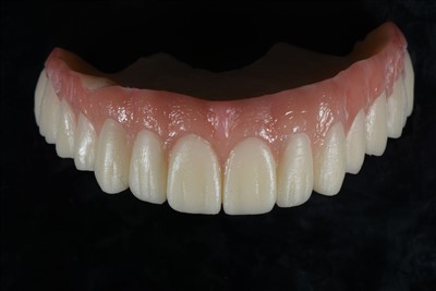 Привремена круна од акрилне смоле